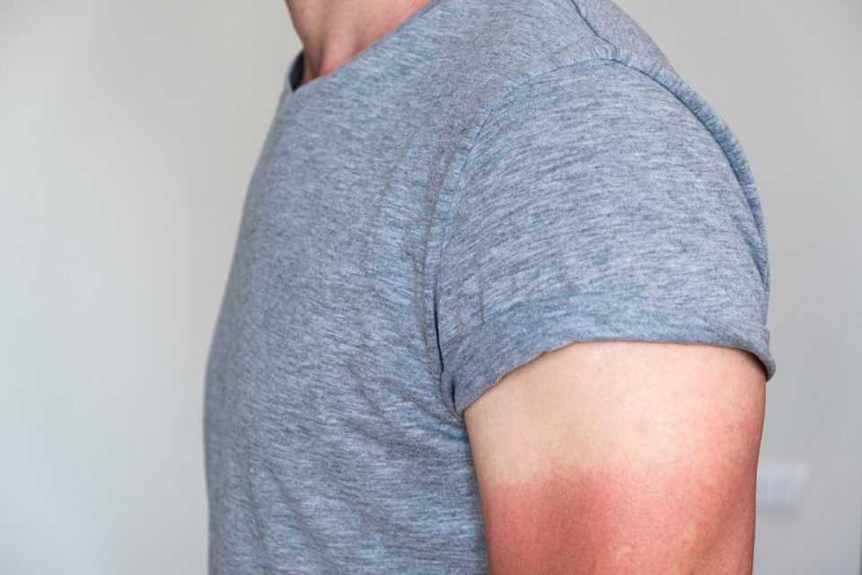 man in a gray t-shirt with a sunburned arm. Visible light and red sunburnt skin.